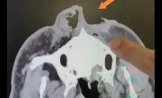驚險(xiǎn)！男子上山采菌被熊咬掉一半鼻子，怎么回事？