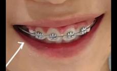矯正牙齒可以報(bào)銷醫(yī)保嗎兒童（矯正牙齒可以報(bào)銷醫(yī)保嗎）